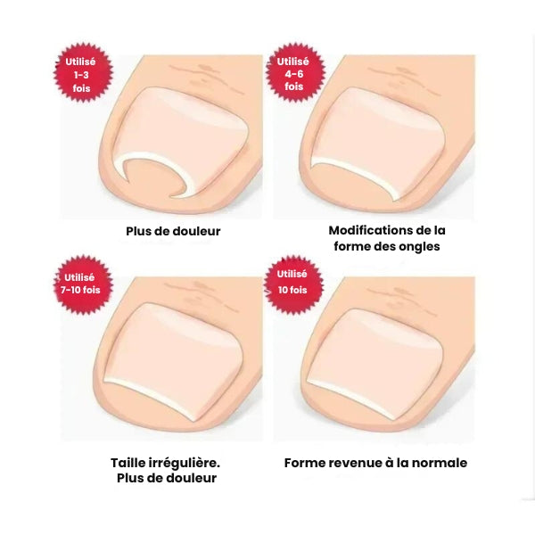 Correcteur d'Ongle Incarné en Acier Inoxydable