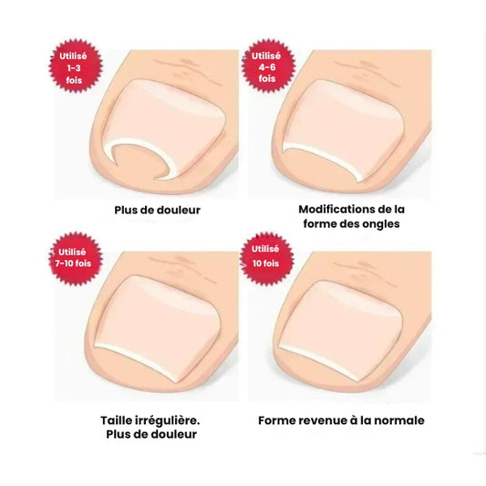 Correcteur d'Ongle Incarné en Acier Inoxydable