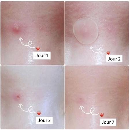 Patchs contre Boutons et Acné BREYLEE™